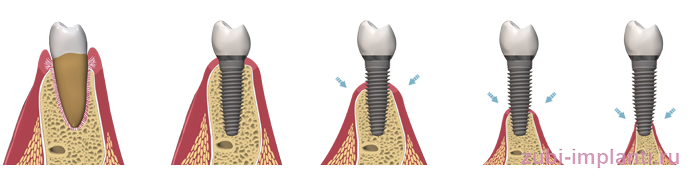 атрофия костной ткани и имплантаци зубов