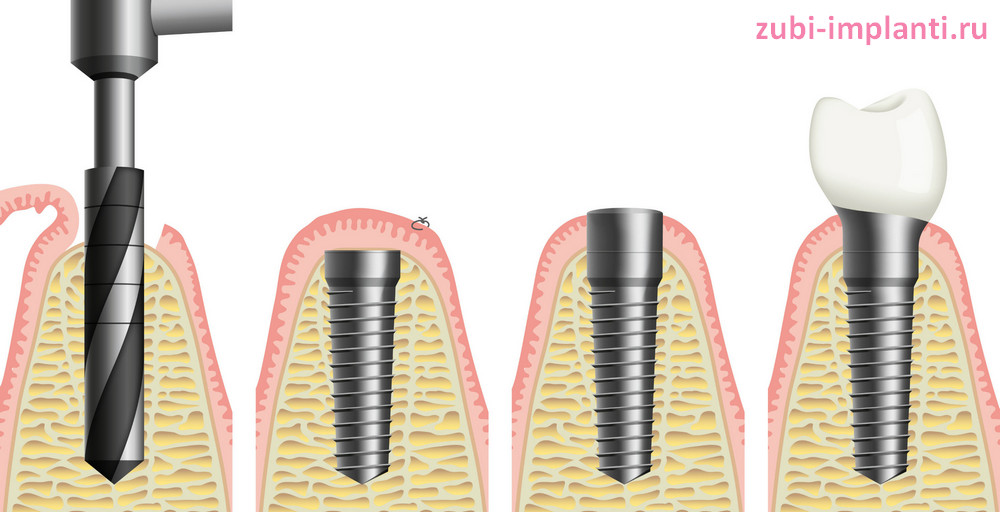 этапы классической имплантации зубов