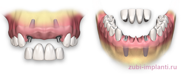 имплантация нескольких зубов