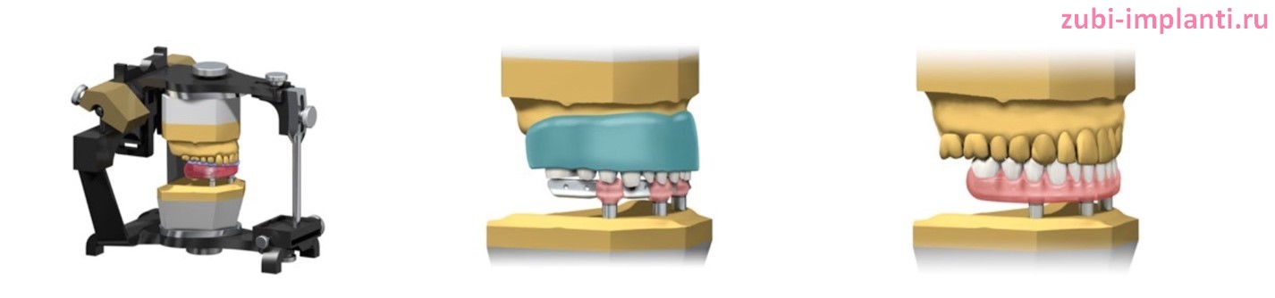 изготовление и фиксация зубного протеза