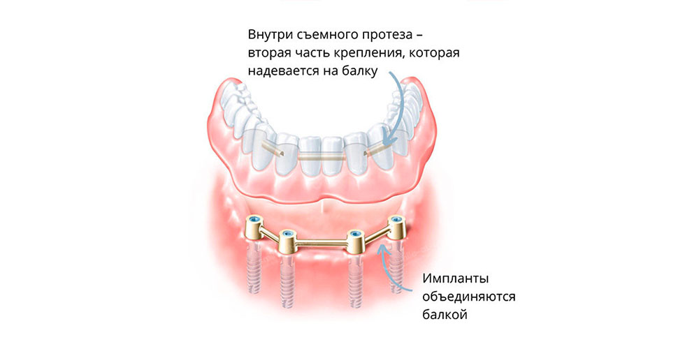 Экваторное крепление или «Локатор» 
Источник информации:
https://www.zubi-implanti.ru/implanti/read/uslovno_siemnie_protezy_na_implantah.html