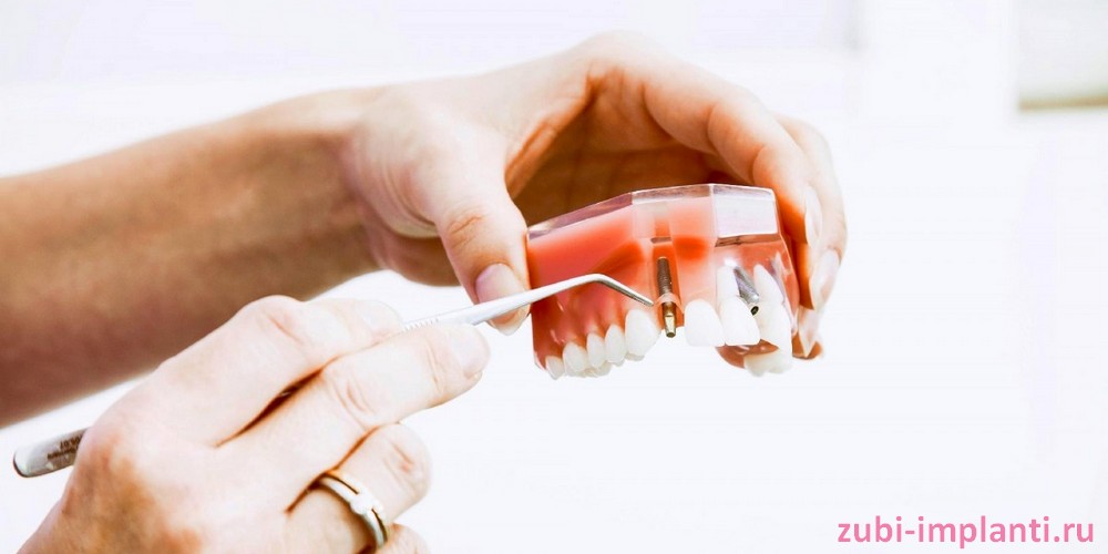 Что такое стабильность зубного импланта