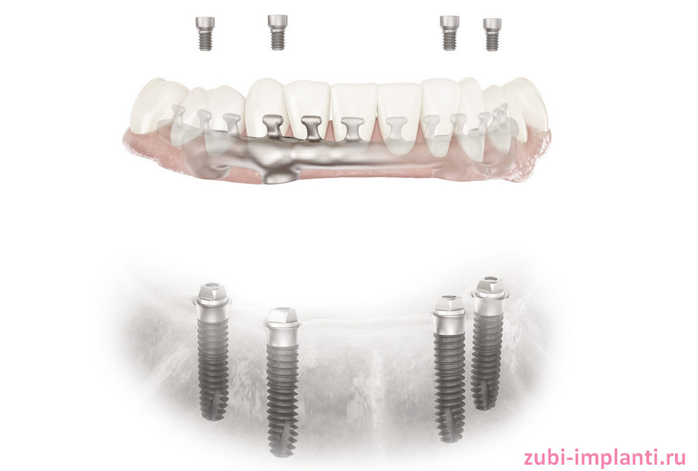 восствновление зубов на 4х имплантах xive