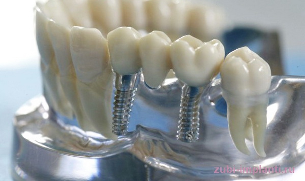 зубной мост на имплантах