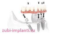 полное протезирование зубов на имплантах