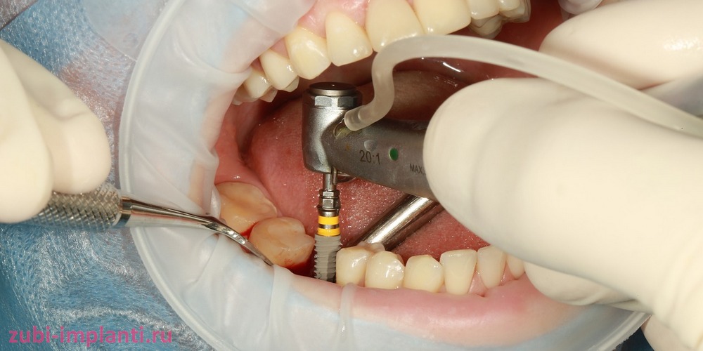 Операция по имплантации зубов за рубежом