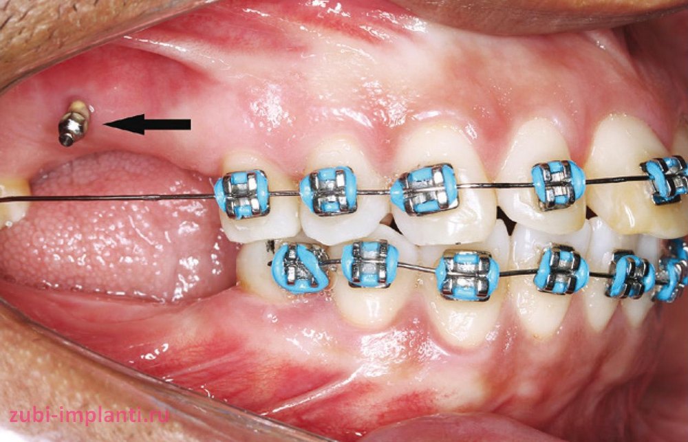 Ортодонтические импланты