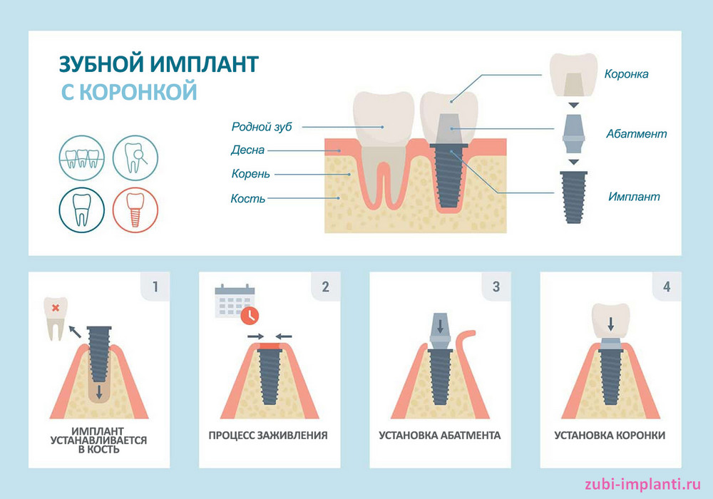 Этапы классической имплантации зубов