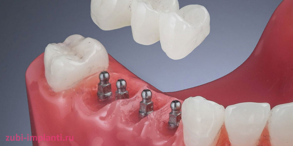 Как выглядит мини импланты зубов