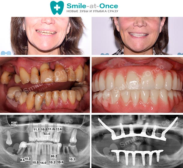 Фото до и после комплексного восстановления зубов