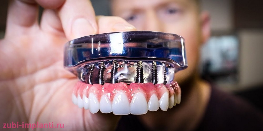 Полное восстановление зубов с помощью имплантации