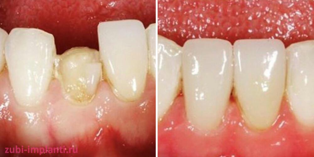 пример восстановления зуба циркониевой коронкой