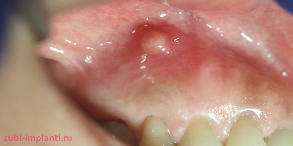 Гнойный абсцесс зуба – причины возникновения