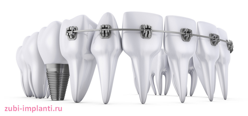 Имплантация зубов с уже установленными брекетами