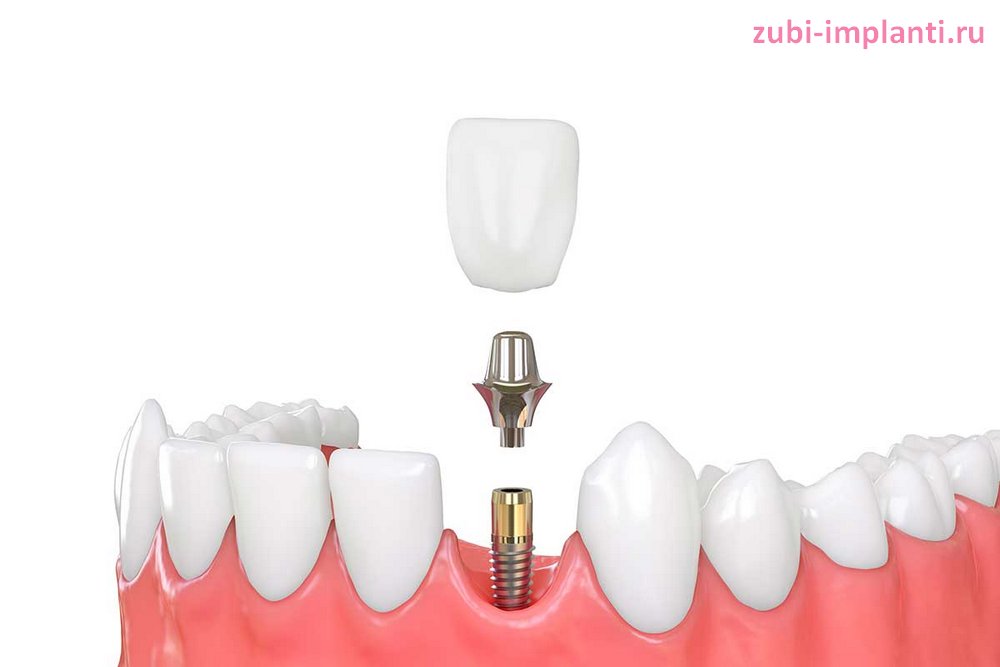 из чего состоит зубной имплант
