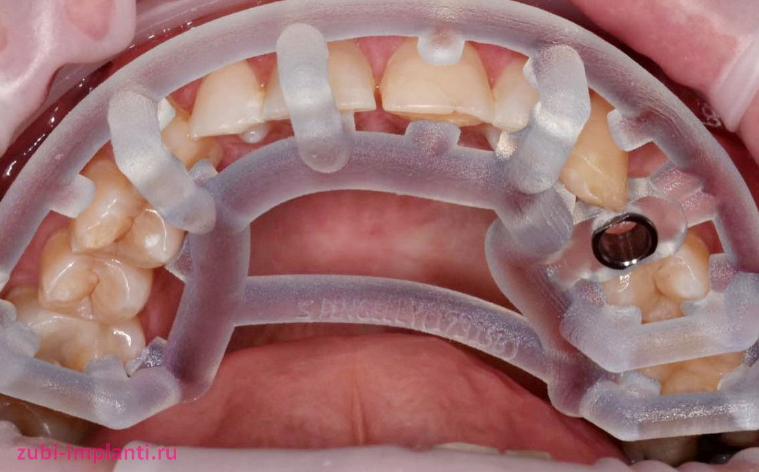 Миниинвазивный способ установки зубного импланта