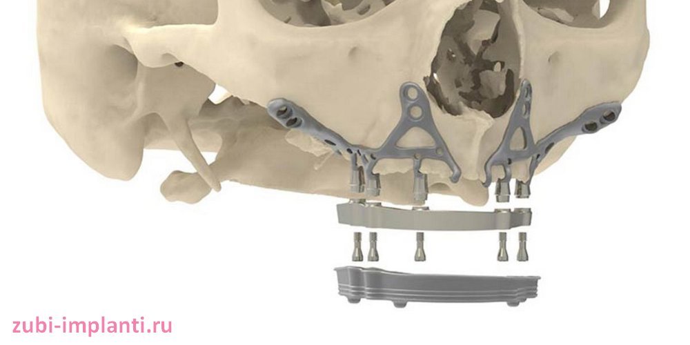 создание 3d модели зубного импланта