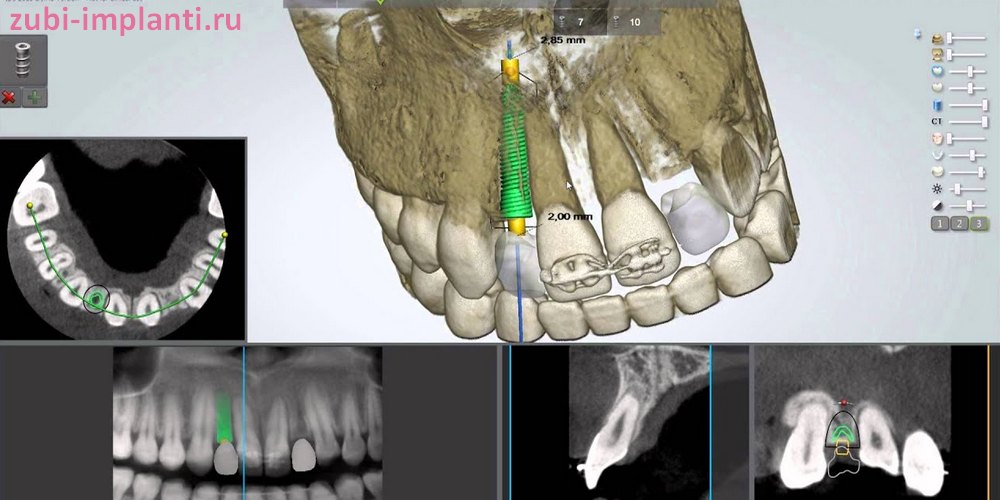 Планирование имплантазии зубов в 3d