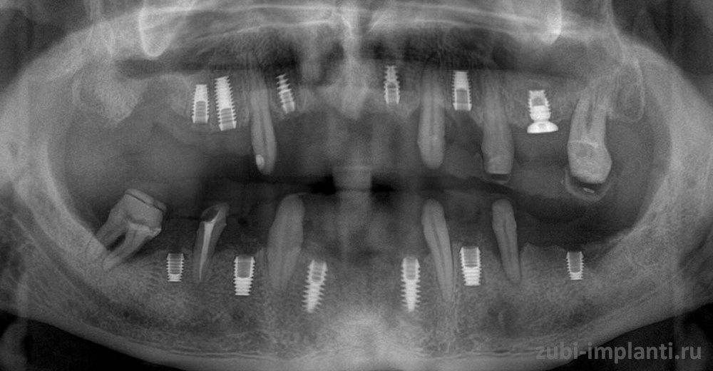 установленные импланты Bicon фото рентген