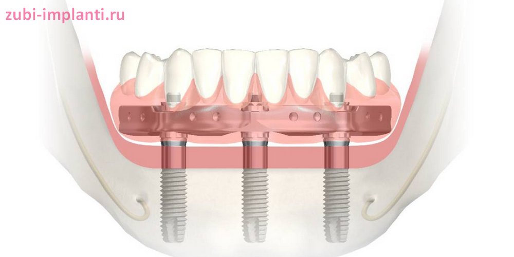 имплантация зубов Trefoil для нижней челюсти
