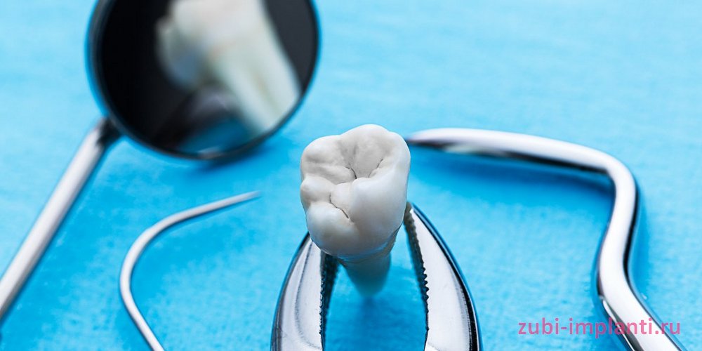 Нужно ли удаление зубов перед имплантацией