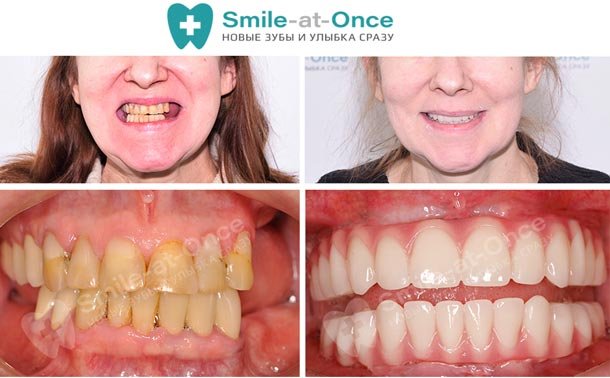 Пример восстановления зубов с помощью имплантации