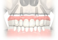 восстановление зубов на 4х имплантах