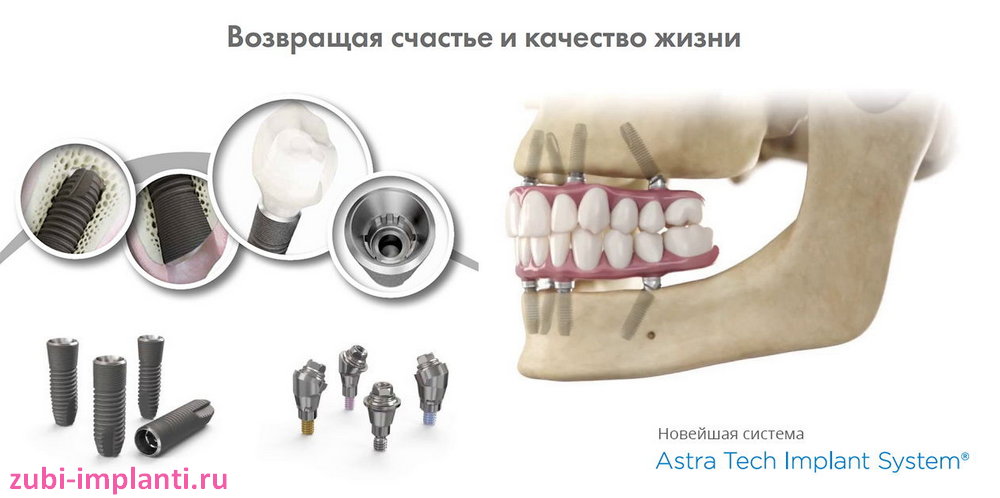 в каких способах восстановления зубов применяется astra tech
