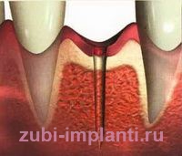 этапы миниинвазивного метода имплантации зубов