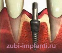 этапы миниинвазивного метода имплантации зубов