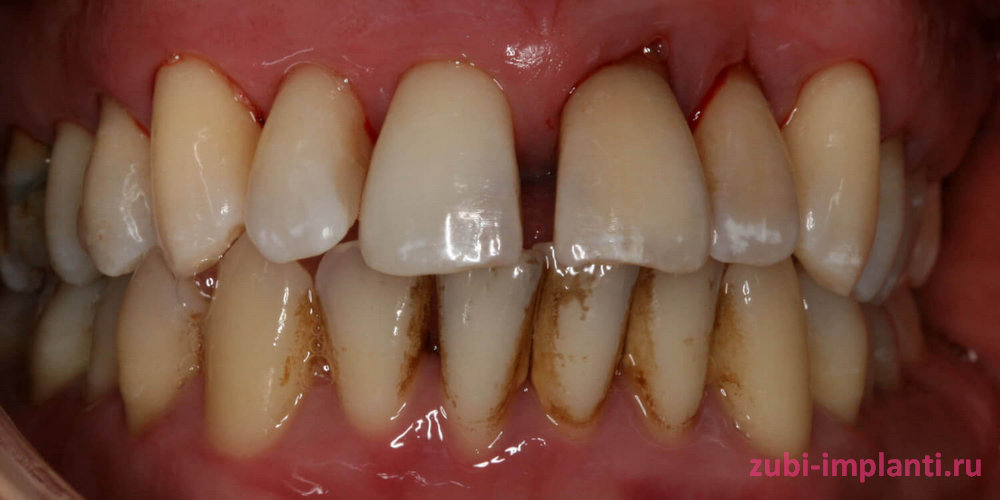 Как выглядит пародонтоз зубов - фото