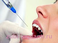 импантация зубов не больно