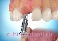 имплантация зубов лоскутным методом