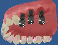 имплантация жевательных зубов - концевой дефект