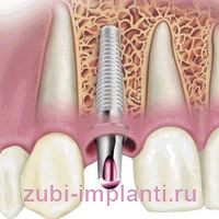 имплантация зубов
