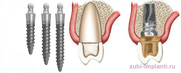 мини-имплантация зубов