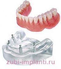 зубные импланты на магнитах