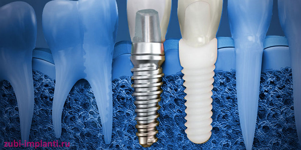 материалы из каких производят зубные имланты
