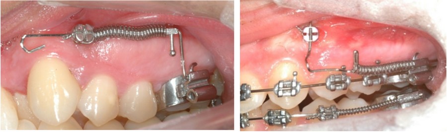 как устанавливаются ортодонтические импланты