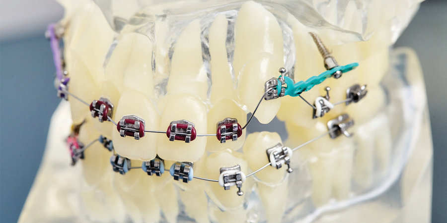 чем выделяются ортодонтические импланты
