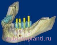 Компьютерное моделирование при имплантации зубов