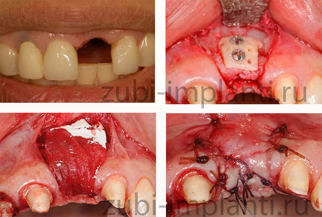фото до и после пересадки костного блока