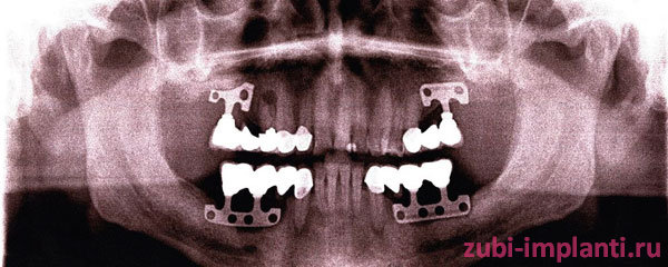 латеральный способ установки зубных имплантов