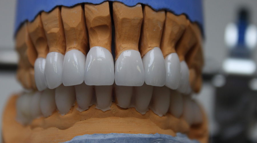 литографическая модель зубов