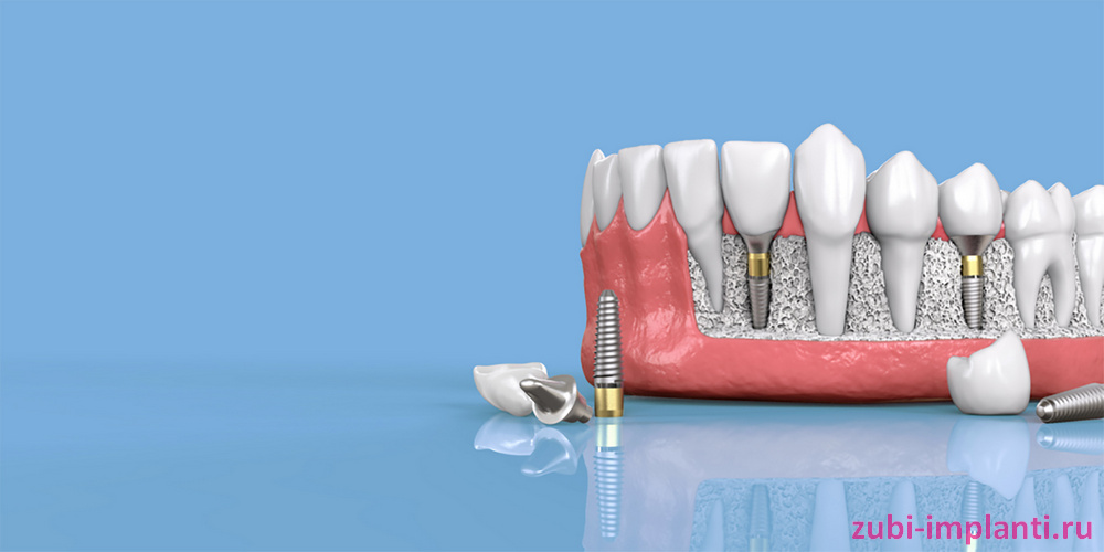 куда могут вживляться зубные импланты