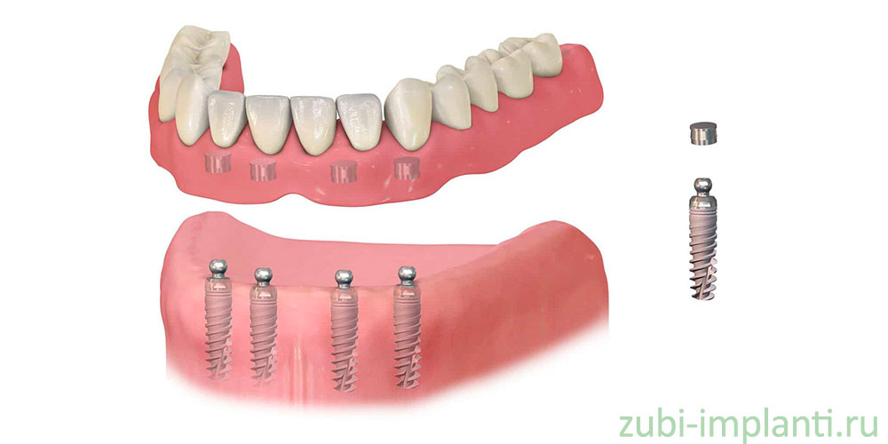 Имплантация на нижней челюсти