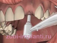 миниинвазивный метод имплантации зубов