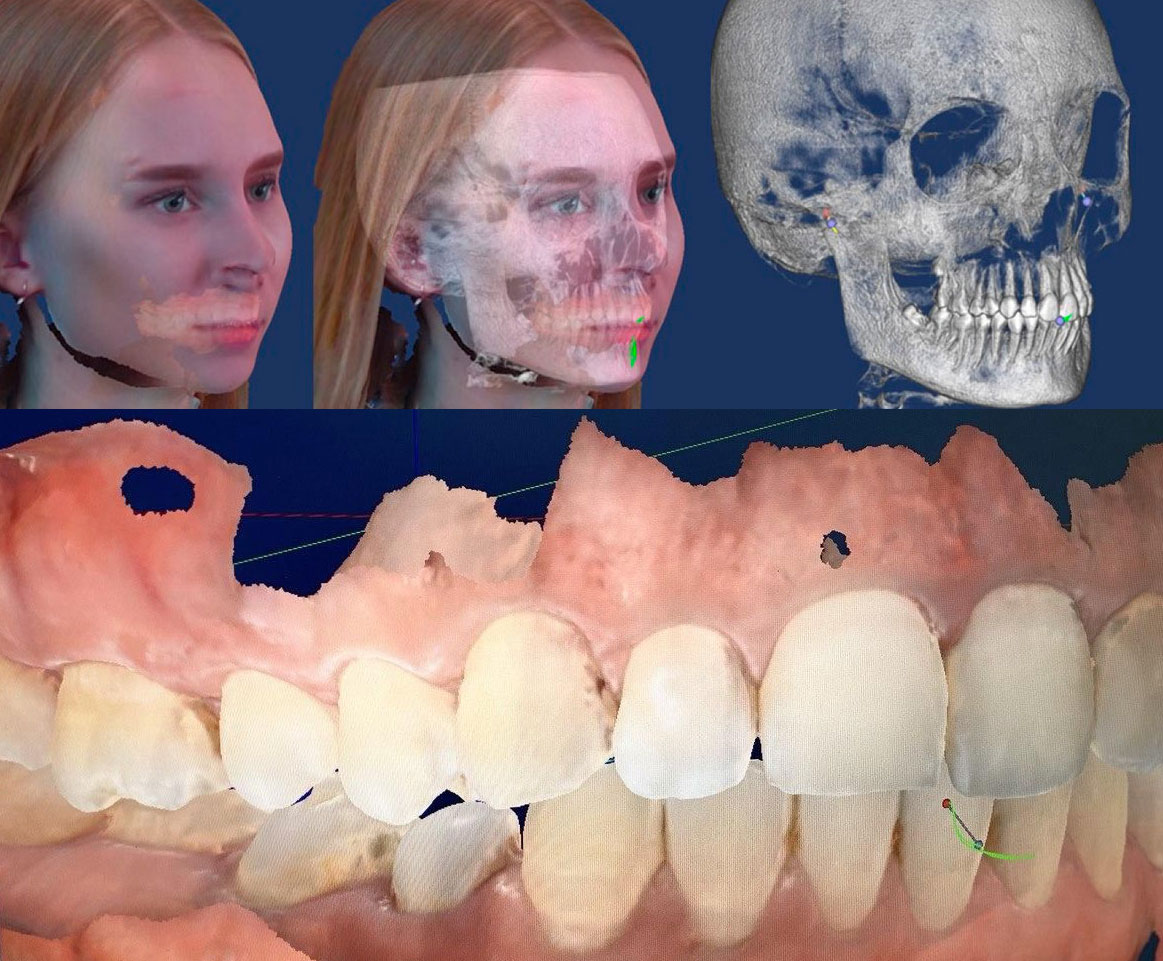 Компьютерное моделирование зубного протеза