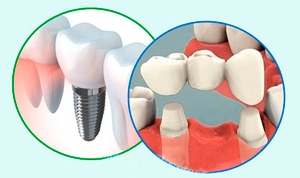 мост или имплант