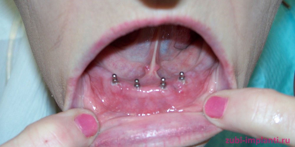 нюансы установки мини имплантов в полости рта